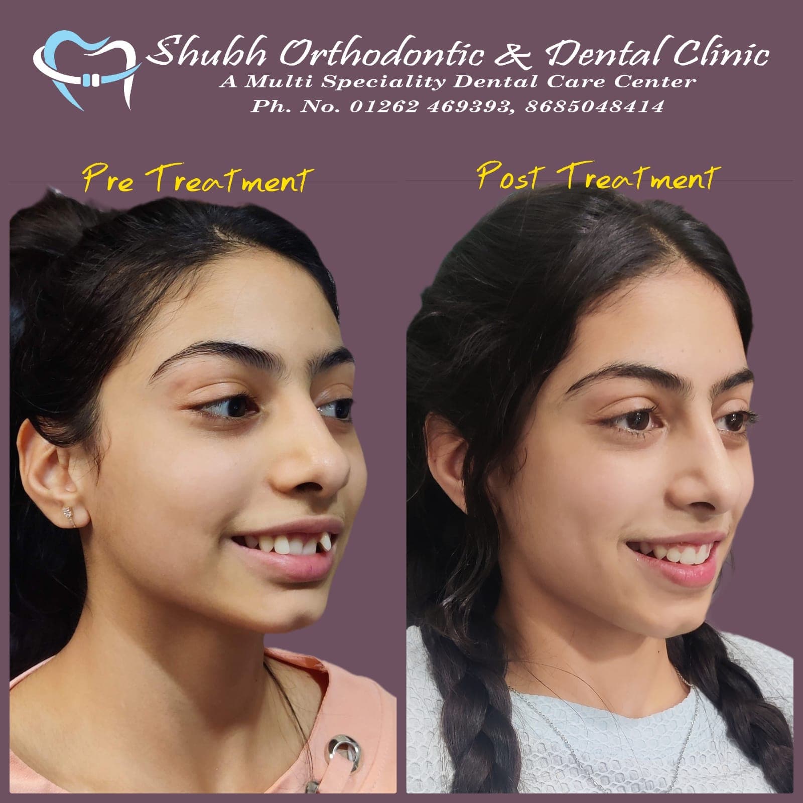 Smile Transformation #7