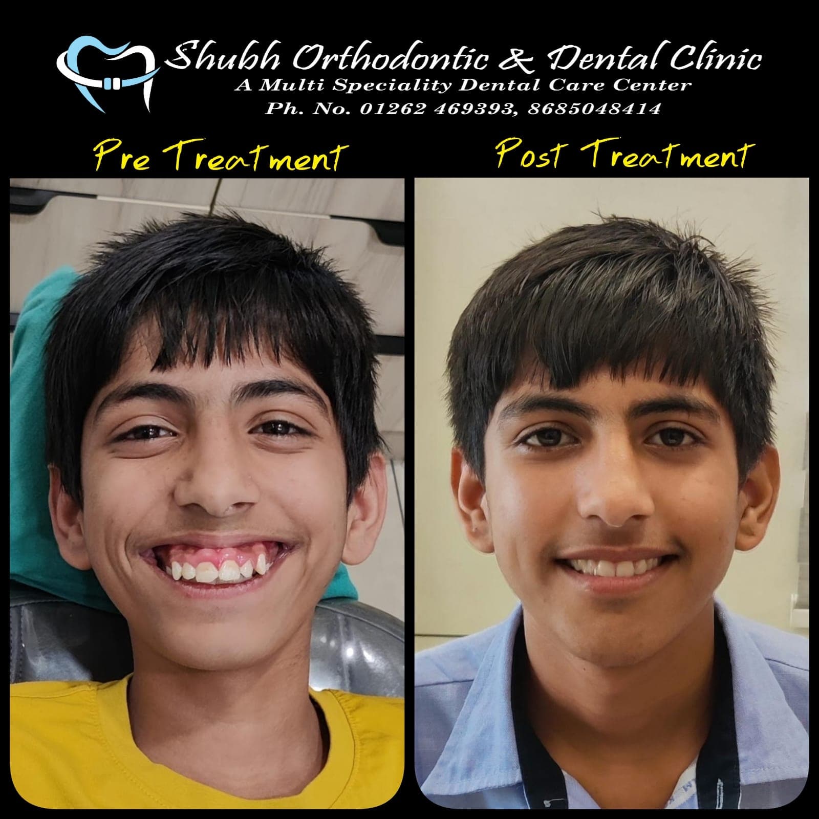Smile Transformation #9