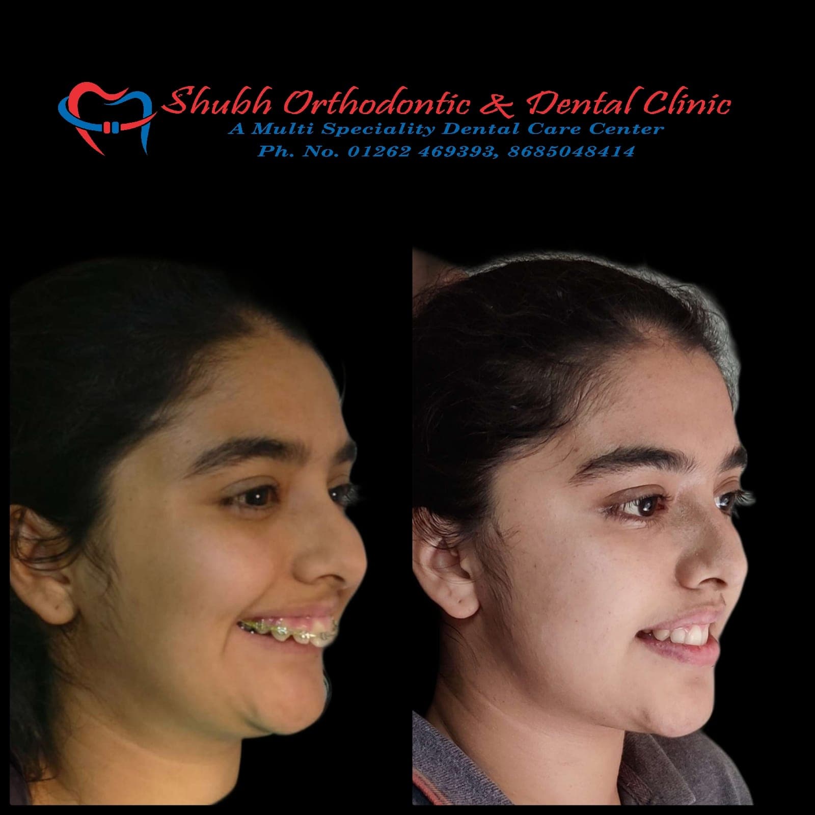 Smile Transformation #11