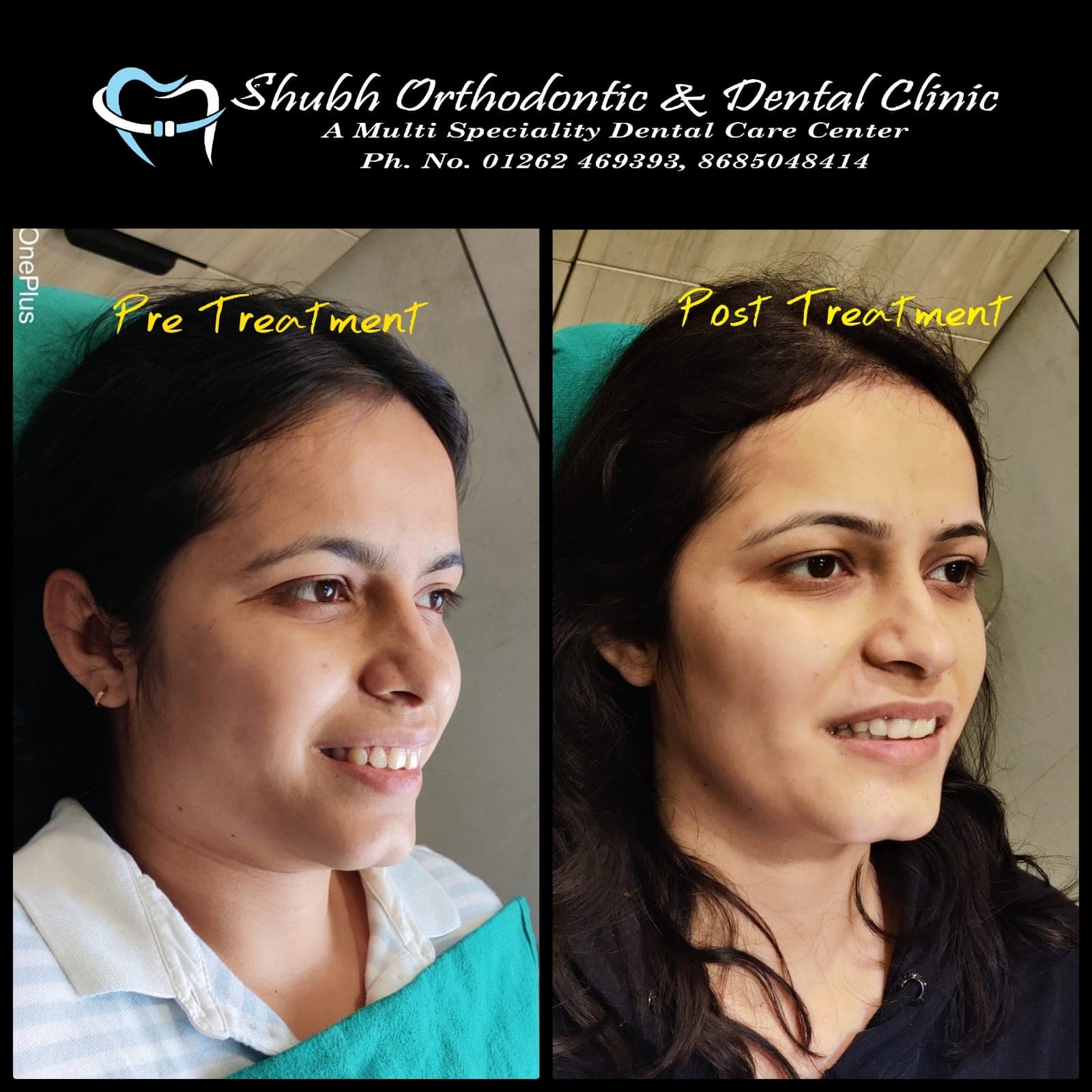 Smile Transformation #12