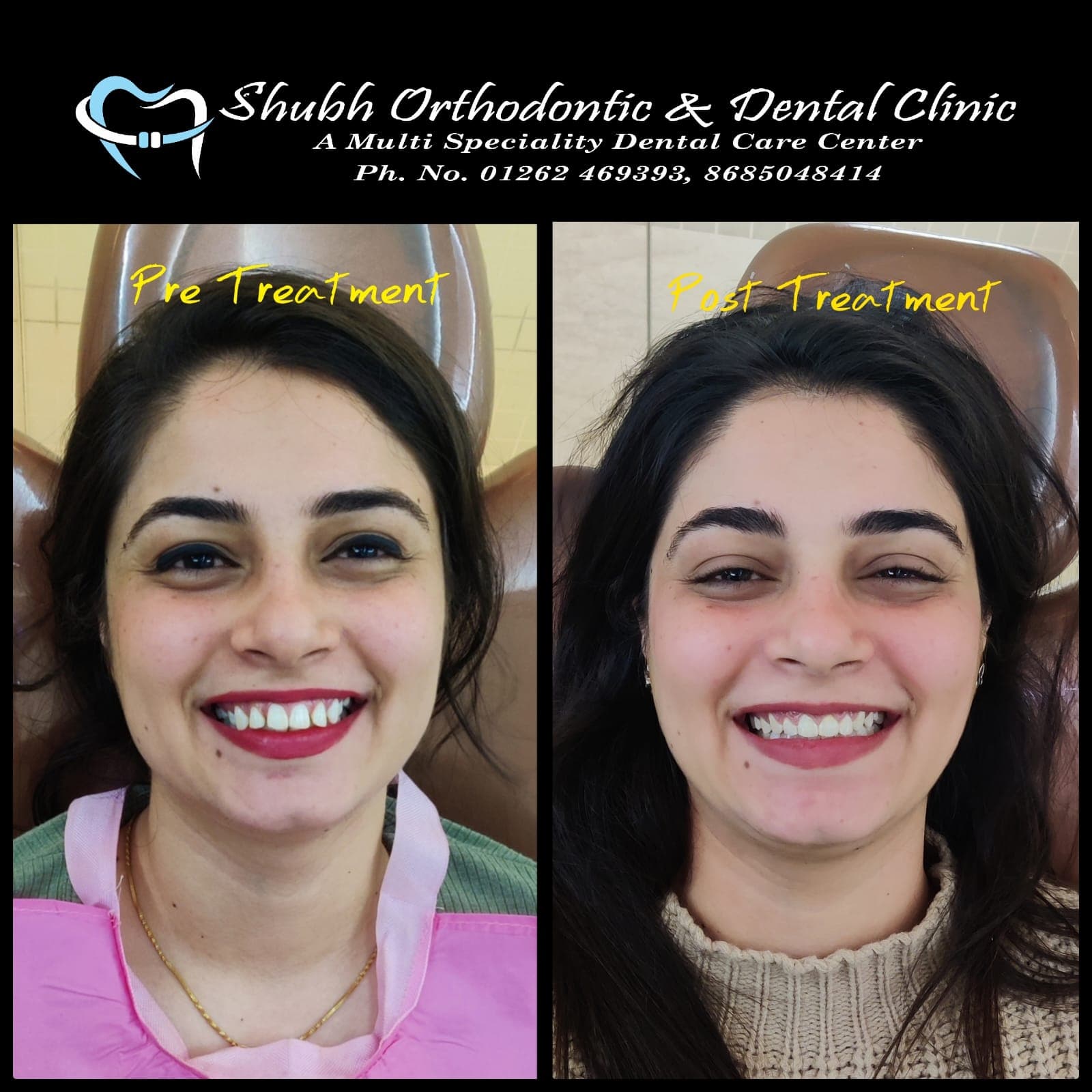 Smile Transformation #15
