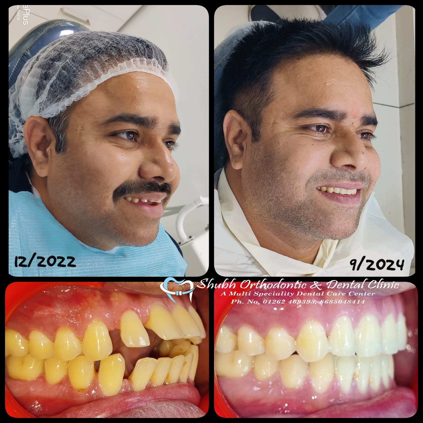 Smile Transformation #16