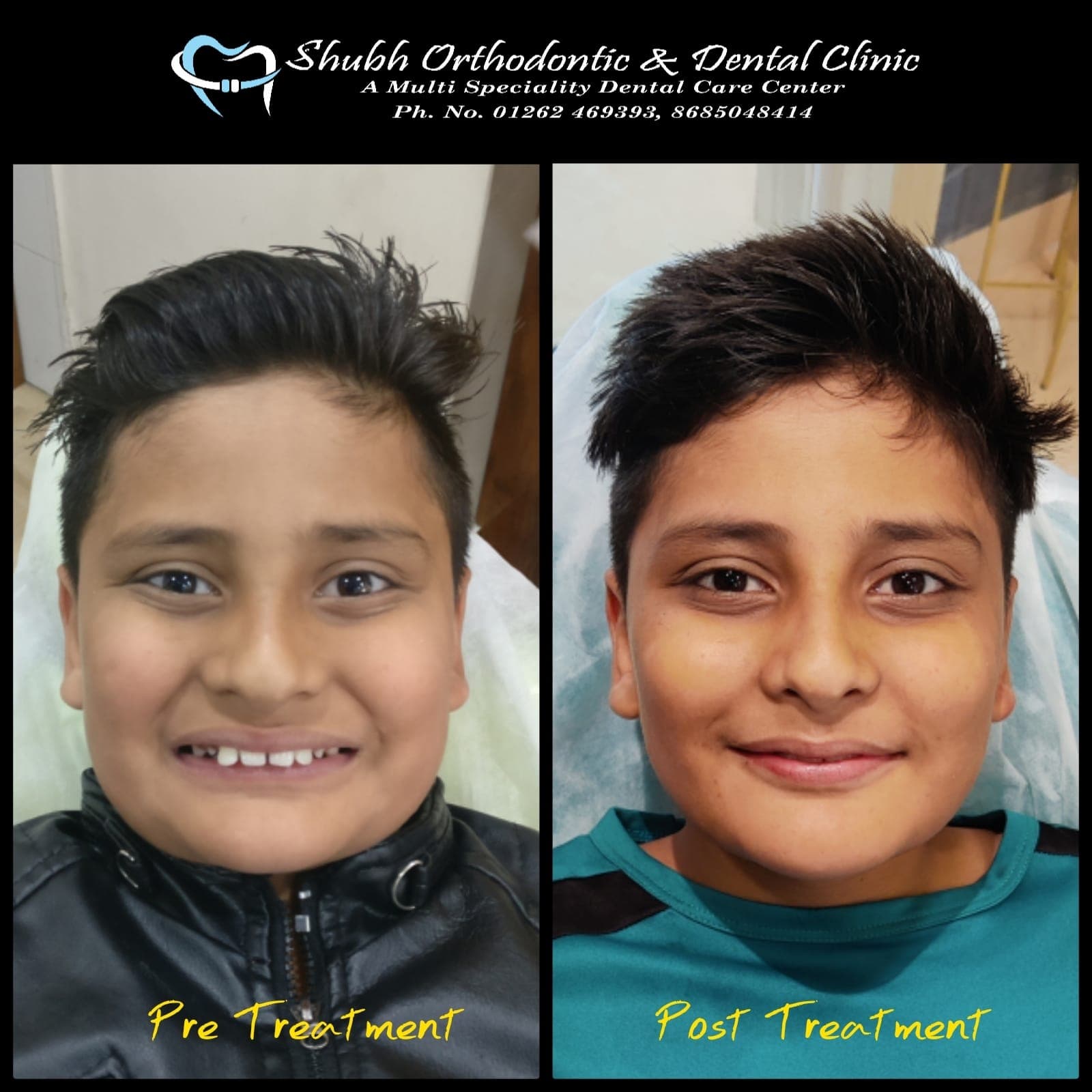 Smile Transformation #20