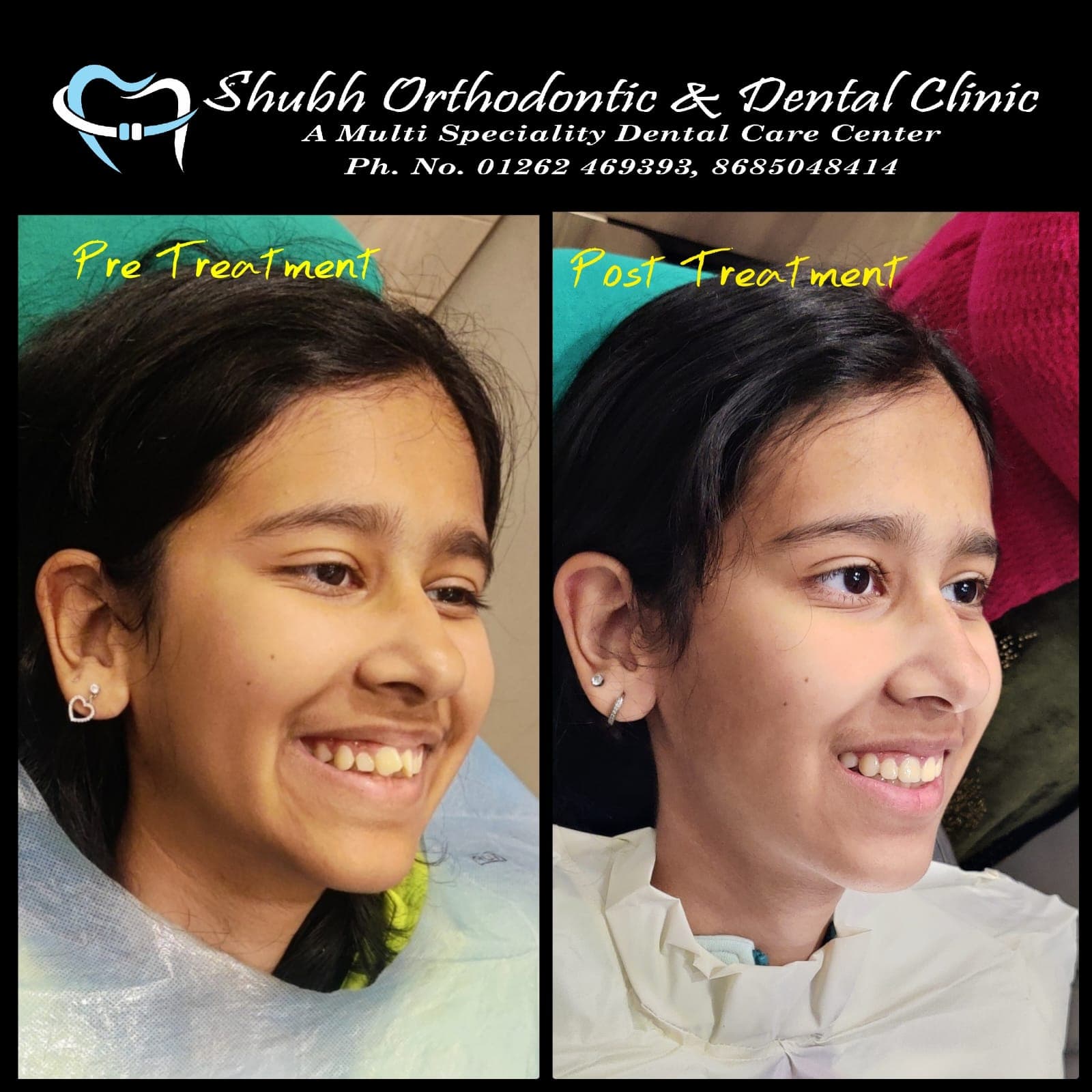 Smile Transformation #21