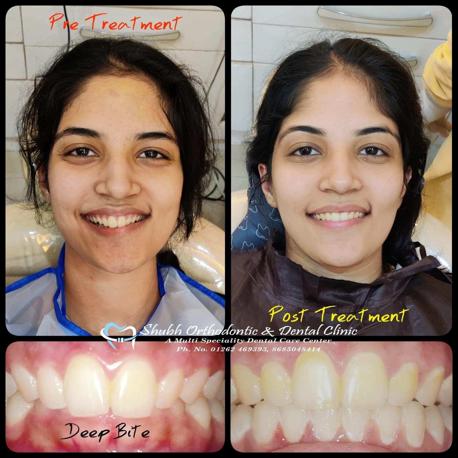 Smile Transformation #24