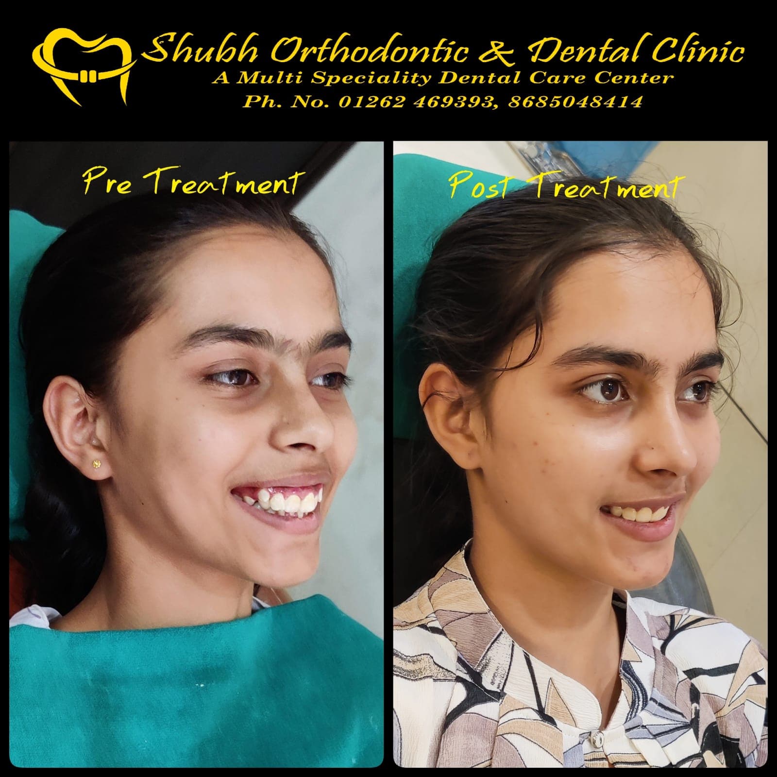 Smile Transformation #26