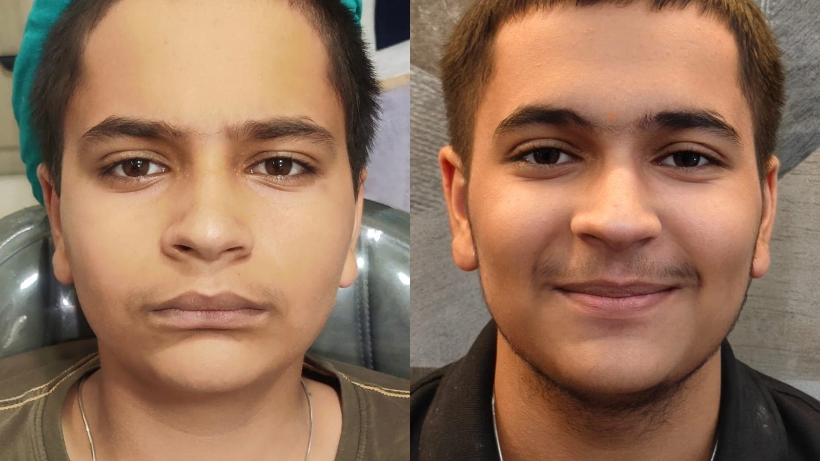 Smile Transformation #28