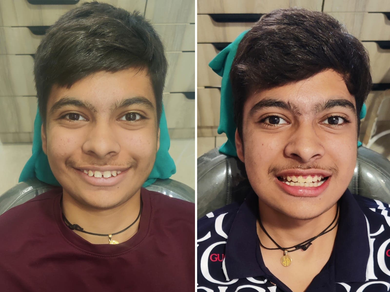 Smile Transformation #29