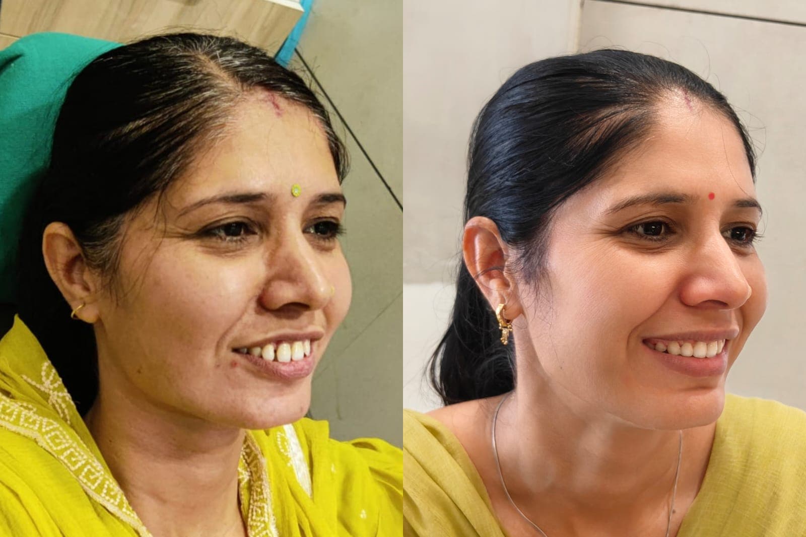Smile Transformation #33