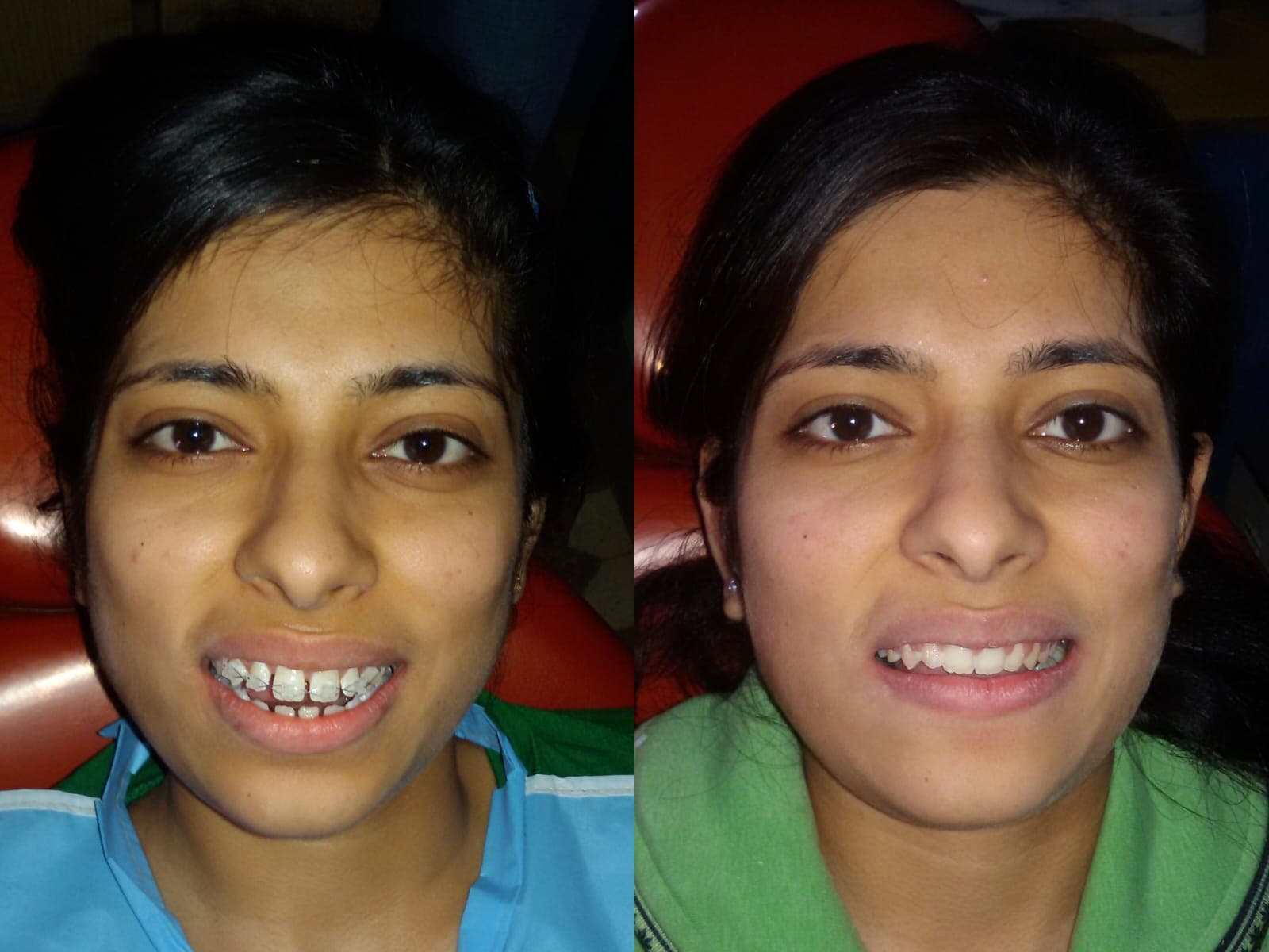 Smile Transformation #35