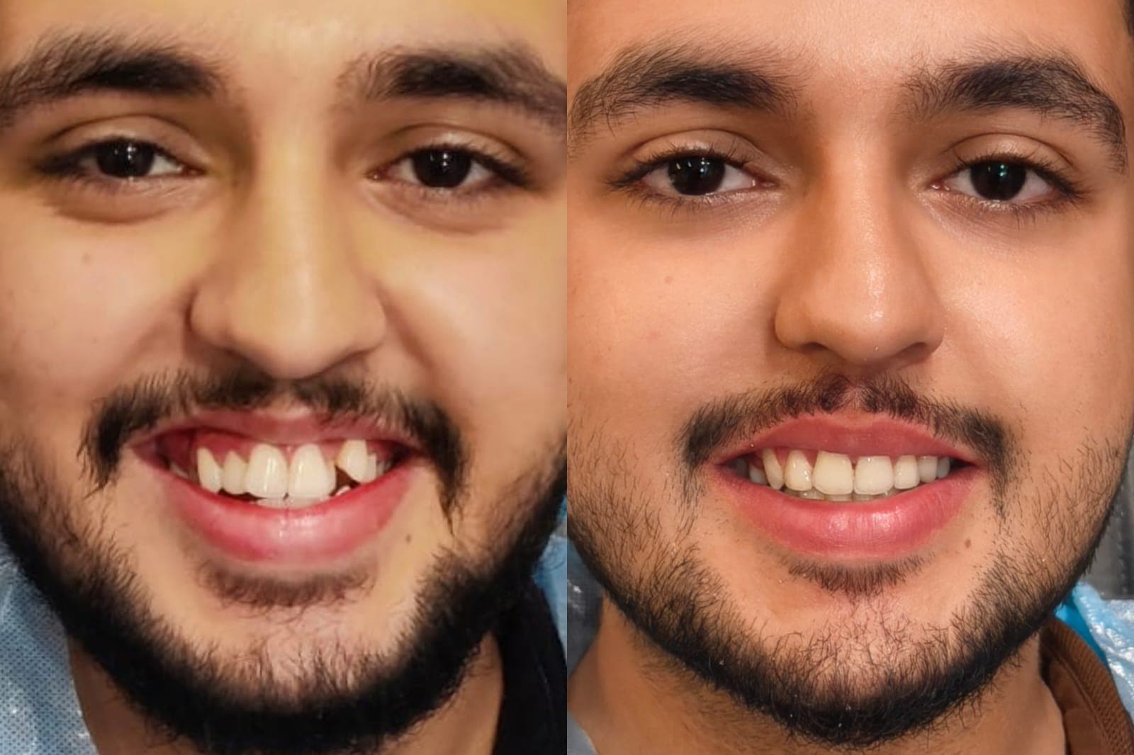 Smile Transformation #36