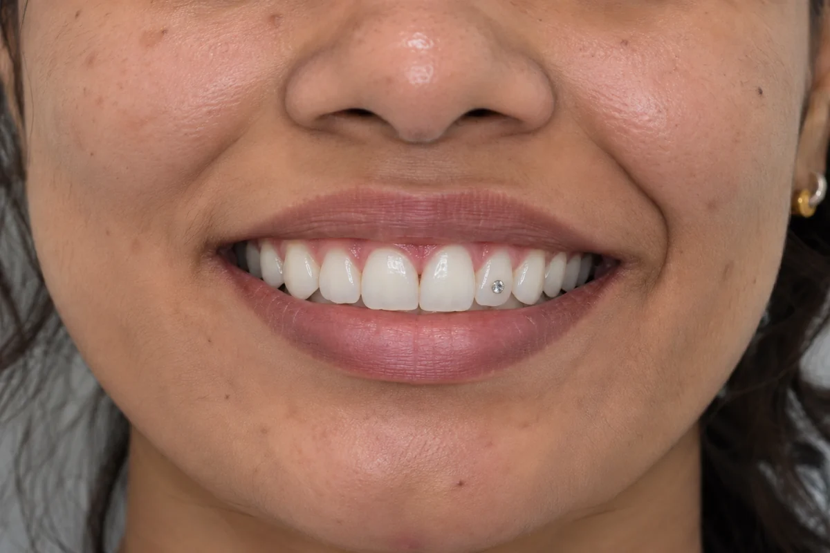 Cosmetic Laser Fillings & Jewellery After Treatment Result