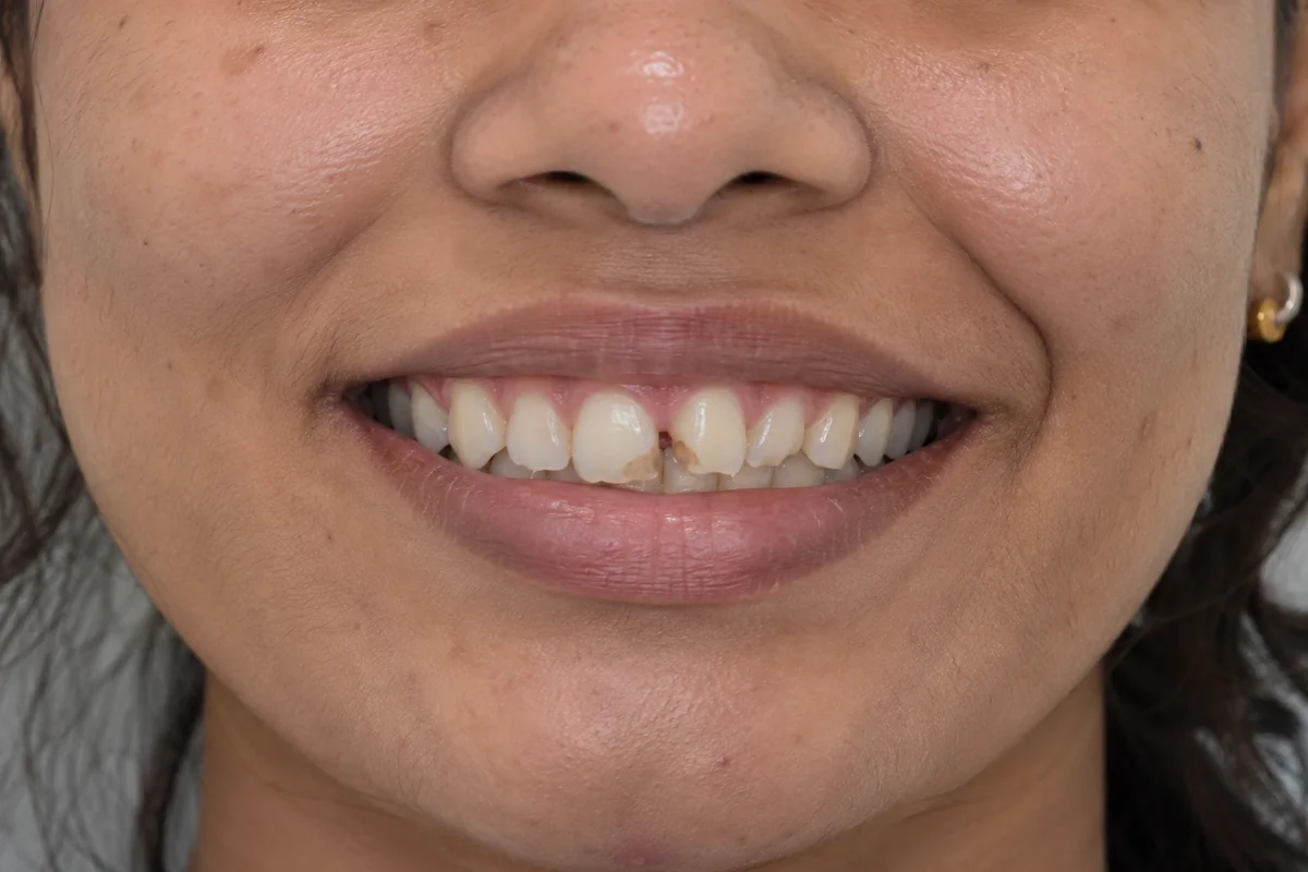 Cosmetic Laser Fillings & Jewellery Before Treatment