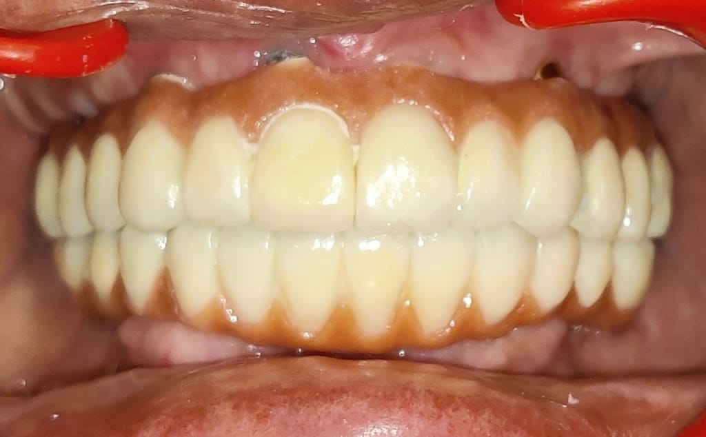 Dental Implants After Treatment Result