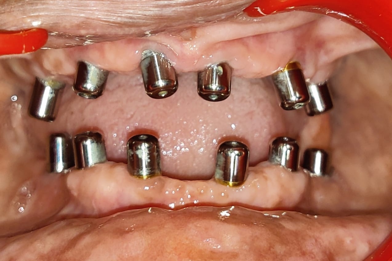 Dental Implants Before Treatment