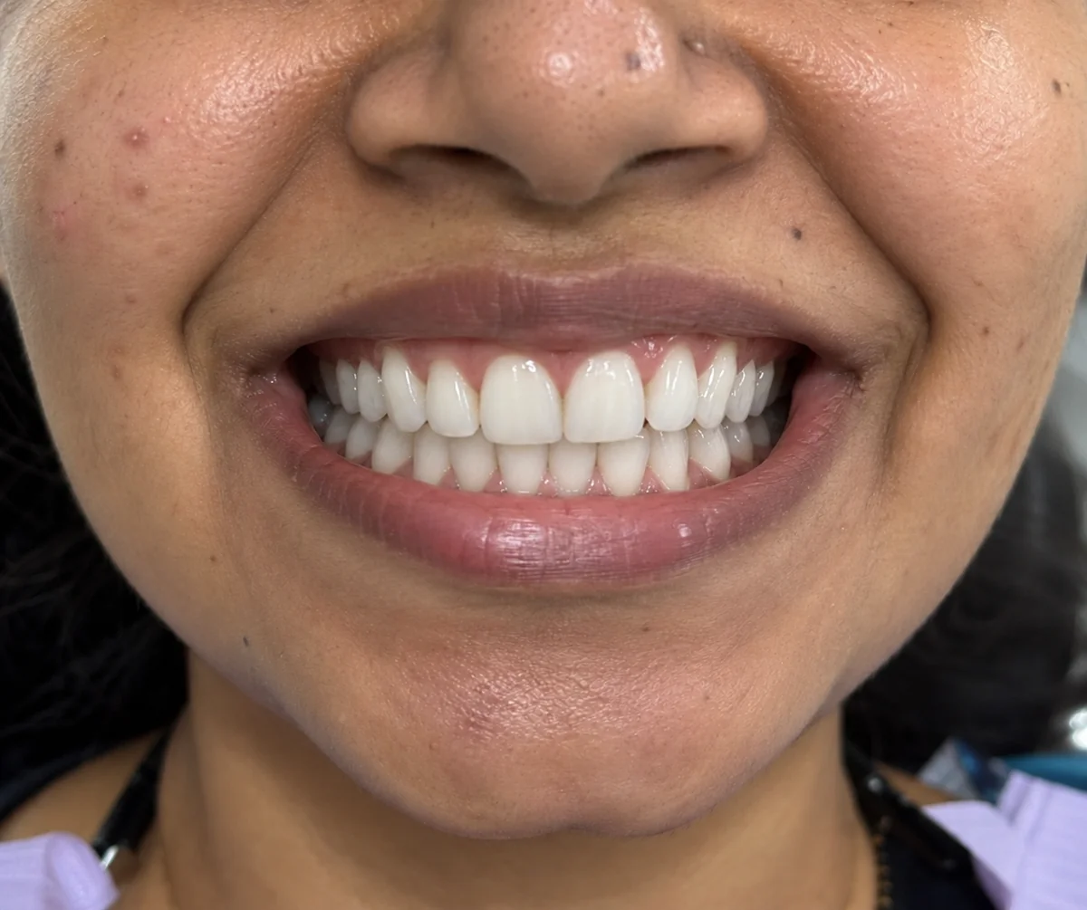 Teeth Whitening After Treatment Result