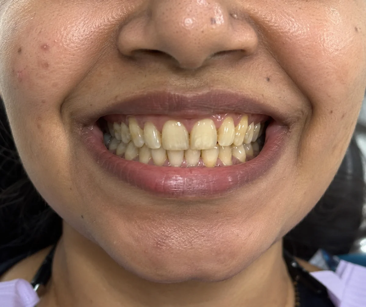 Teeth Whitening Before Treatment